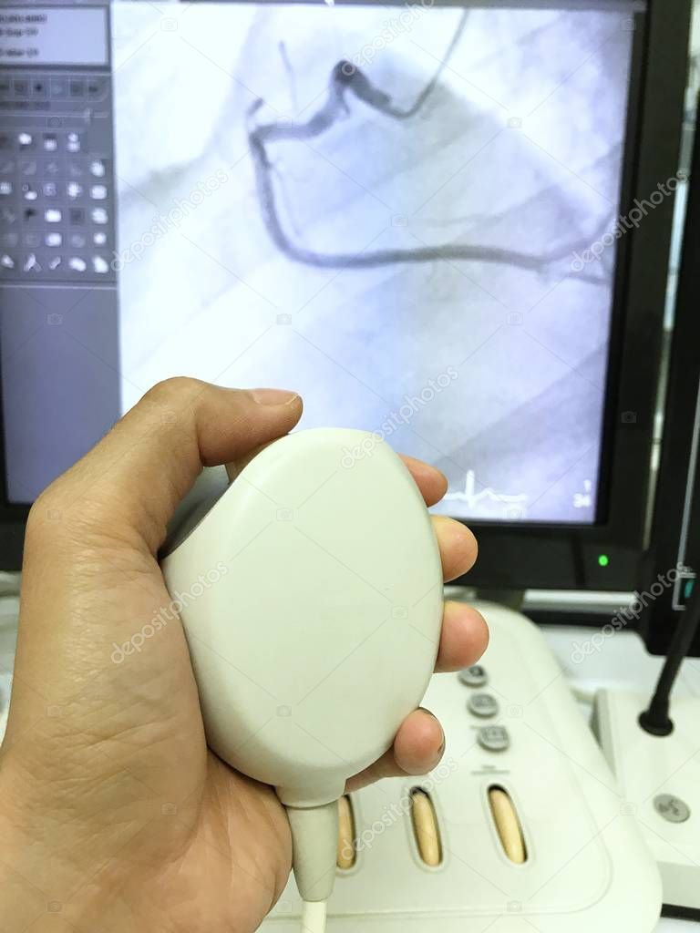 Focus at left hand is pressing controller for coronary angiogram, background is blurred of right coronary artery (RCA) cine on x-ray screen, in catheterization room, hospital.