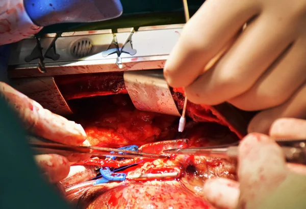 A doctor is connecting graft vessel with coronary artery in off pump coronary artery bypass surgery (OPCAB) with stabilization tool for stable narrow area.