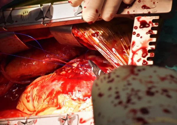 Médico Está Conectando Injerto Vaso Arteria Coronaria Cirugía Bypass Arteria —  Fotos de Stock