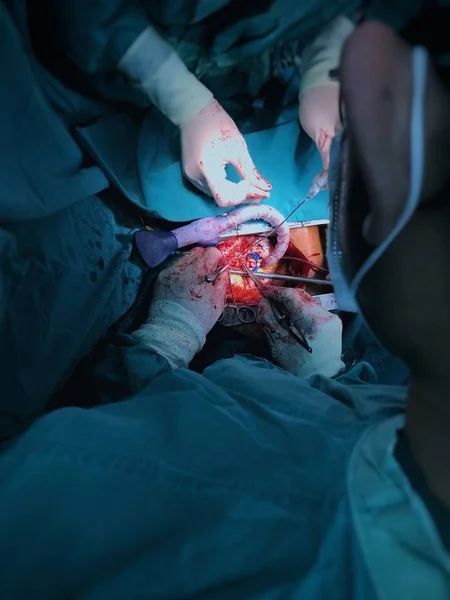 Doktor Používá Vnější Transplantaci Koronární Tepny Mimo Metodu Čerpadla Pohled — Stock fotografie
