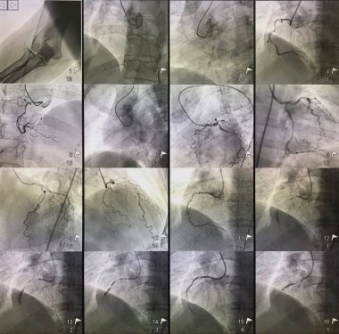 Kateterizasyon laboratuvarında balon ve stent kullanımı ile Perkütan Koroner Girişim (Pci) olgularında koroner arterin obstrüksiyon tedavisine ait 12 adet resim.