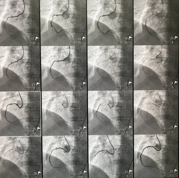 Imagini Ale Tratamentului Obstrucției Artera Coronariană Dreaptă Rca Cazul Intervenției — Fotografie, imagine de stoc