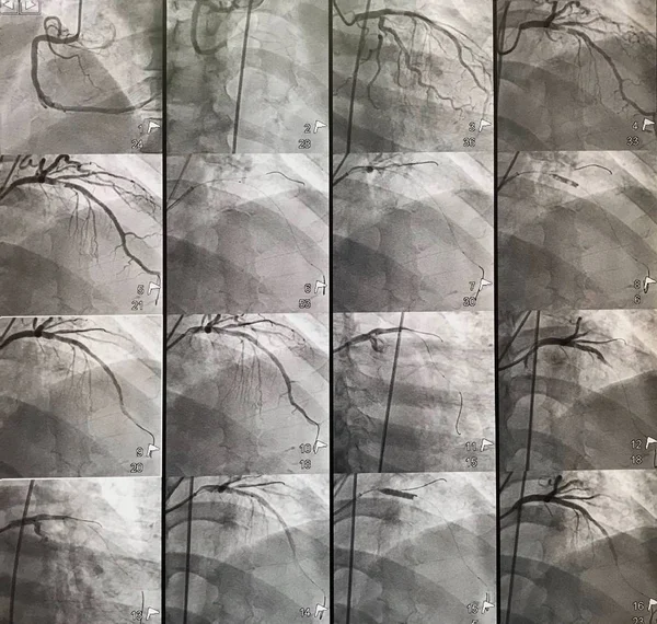 Imagini Ale Tratamentului Obstrucției Artera Anterioară Stângă Descendentă Cazul Intervenției — Fotografie, imagine de stoc