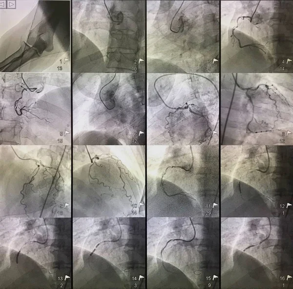 12张在导管实验室使用气球和支架治疗皮皮冠状动脉的冠状动脉的图片 免版税图库图片