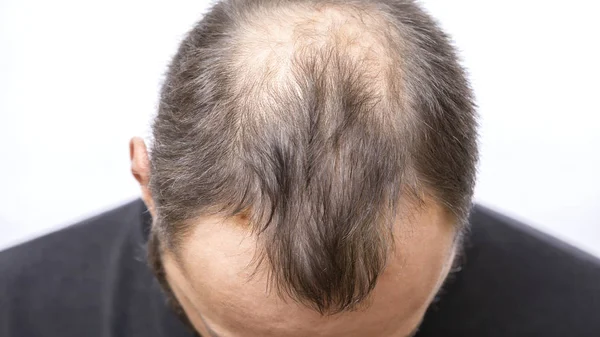 Joven calvo, Problema de pérdida de cabello —  Fotos de Stock