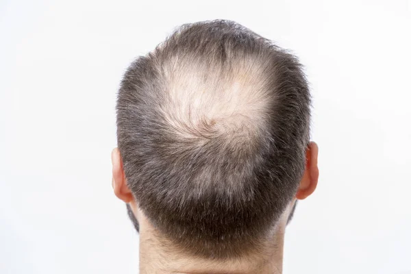 Hombre calvo tiene un problema de calvicie de cabeza y pérdida de cabello —  Fotos de Stock