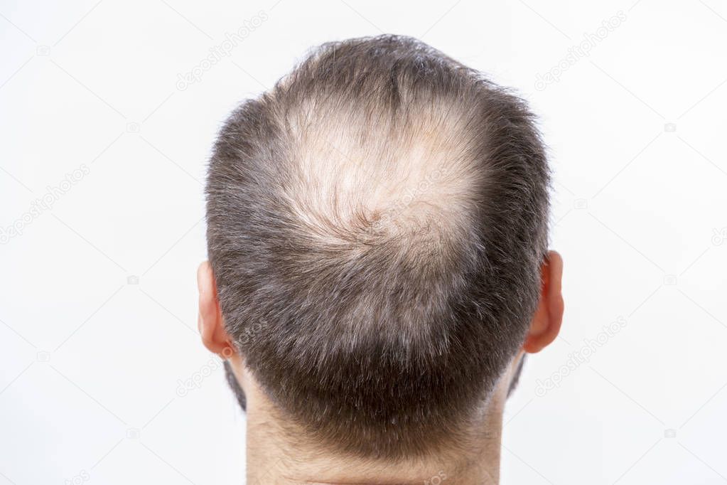 Bald man has a problem of head baldness and hair loss 