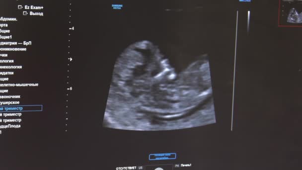 Onderzoek Van Foetus Door Echografie — Stockvideo