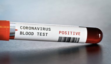 Kan örneği şişesi, etikette koronavirüs testi pozitif sonuç diyor. (çıkartma kendi tasarımı, sahte barkod). Covid-19 salgın konsepti