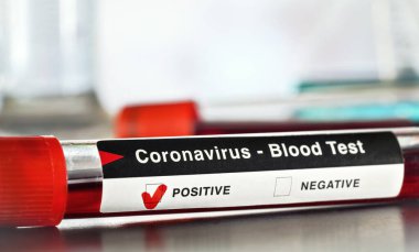 Kan örneği şişesi, etikette koronavirüs testi pozitif sonuç diyor. Bulanık laboratuvar ekipmanı geçmişi. Salgın konsepti sırasında Covid-19 testi
