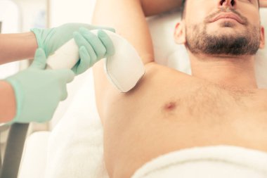 Koltuk altı bölgesinde vakum emme ile lazer epilasyon işlemi geçiren sakallı adam
