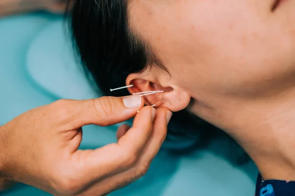 物理治疗师做针灸对一个年轻的女人在她的耳朵 — 图库照片