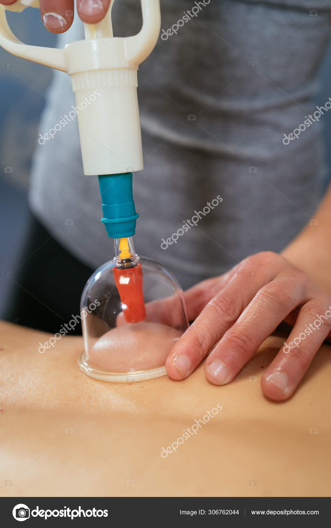 Detalle Fotográfico Fisioterapeuta Que Fija Una Ventosa Espalda