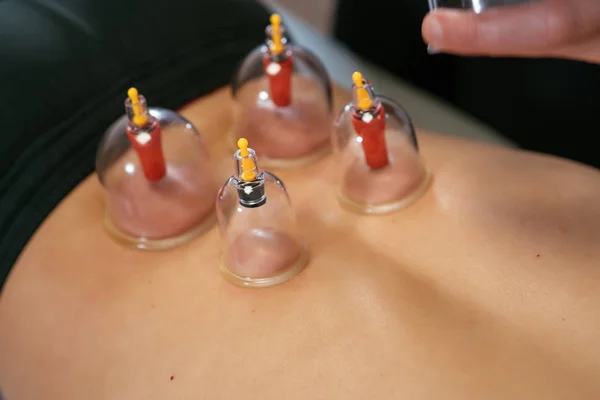 患者の背中に取り付けられた4つの透明な吸引カップ 吸引カップでの理学療法 — ストック写真
