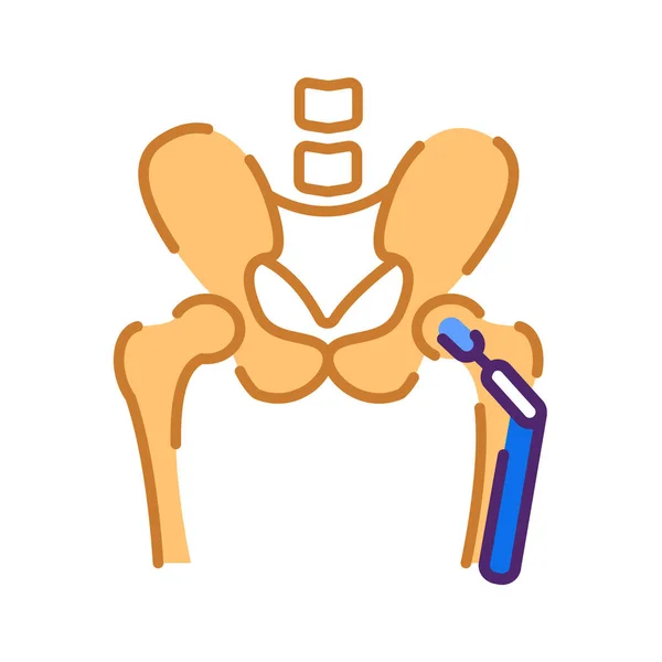 Artrose Platte Kleur Pictogram Heupvervangend Implantaat Het Bekken Teken Voor — Stockvector