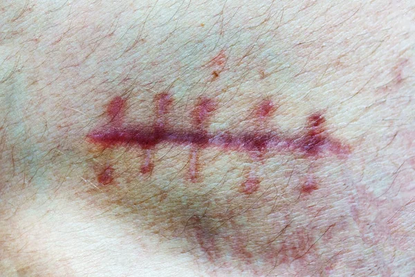 Ferito Sul Corpo Umano Primo Piano Della Cicatrice Cucitura Sulla — Foto Stock