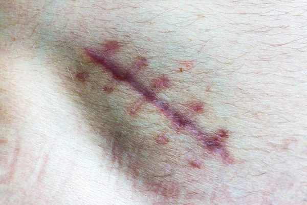 Herida Cuerpo Humano Cicatriz Cerca Costura Piel Del Corte —  Fotos de Stock