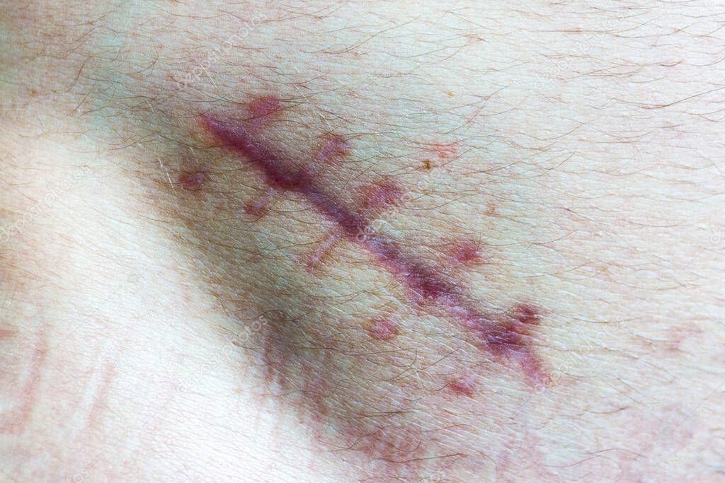 Wound on the human body. scar close-up. seam on the skin from the cut