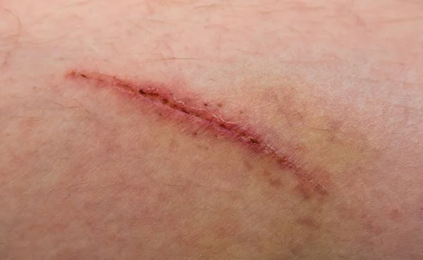 Uma Ferida Corpo Humano Sutura Velha Corte Profundo Cicatriz Perto — Fotografia de Stock