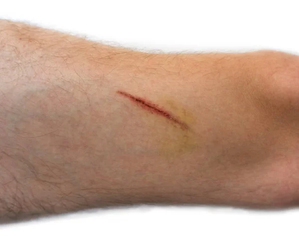 Uma Ferida Corpo Humano Sutura Velha Corte Profundo Cicatriz Close — Fotografia de Stock
