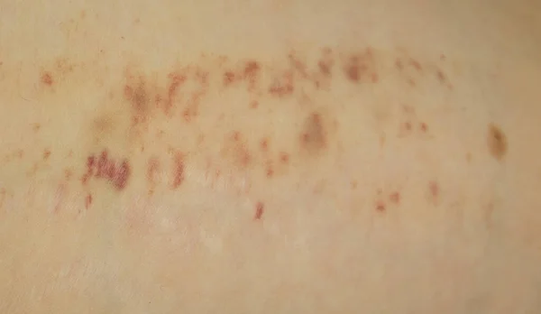 Blutergüsse Und Kratzer Auf Der Haut Textur Hintergrund — Stockfoto