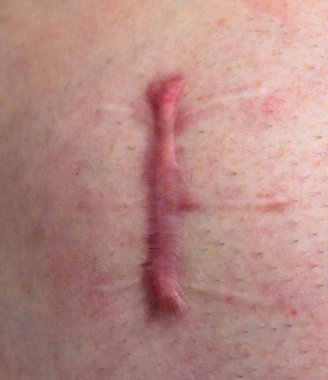 İnsan vücudunda bir yara, uzun bir dikiş, derin bir kesik, yakın plan yara, karnında kesik.