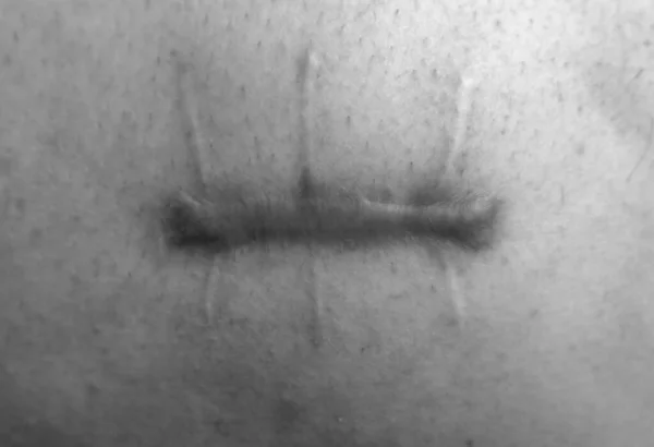 Una Herida Cuerpo Humano Sutura Prolongada Corte Profundo Cicatriz Cerca —  Fotos de Stock