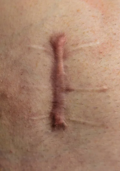 人間の体に負傷し 縫合が長く 深いカット 傷のクローズアップ 腹部への切開 — ストック写真