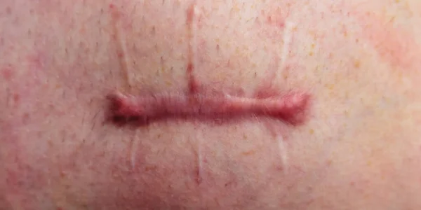 Ferito Sul Corpo Umano Sutura Lunga Taglio Profondo Cicatrice Primo — Foto Stock