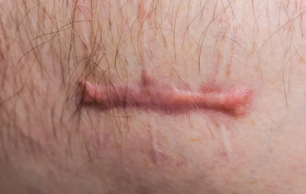 Wounded Human Body Suture Protracted Old Deep Cut Scar Close — Stock Photo, Image