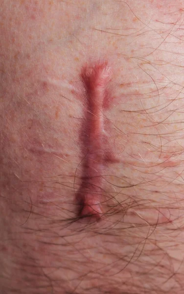 Ferito Sul Corpo Umano Sutura Lunga Taglio Profondo Cicatrice Primo — Foto Stock