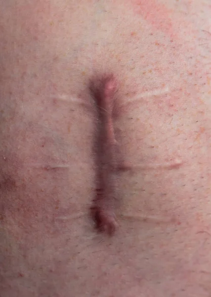 Wounded Human Body Suture Protracted Old Deep Cut Scar Close — Stock Photo, Image