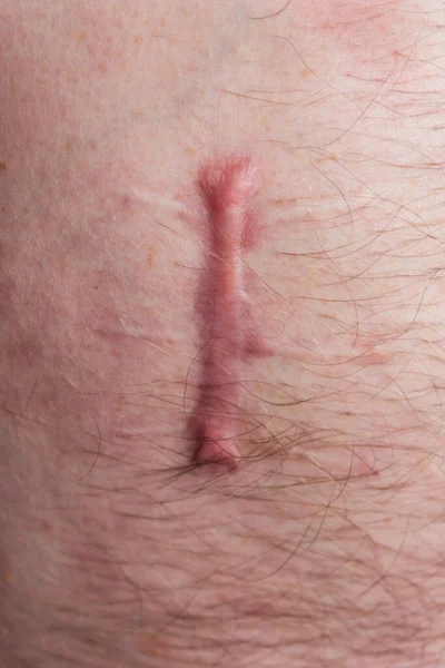 Wounded Human Body Suture Protracted Old Deep Cut Scar Close — Stock Photo, Image