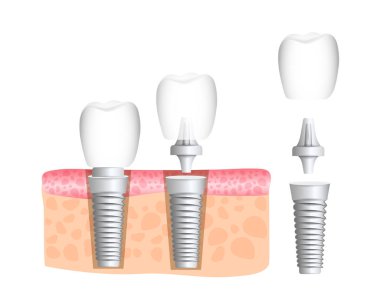 Gerçekçi implant diş yapısı ile tüm parçaları: crown, ayağına, vida. Diş Hekimliği. İnsan dişleri implantasyonu. Vektör çizim