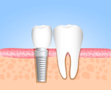 Gerçekçi implant diş yapısı ile tüm parçaları: crown, ayağına, vida. Sağlıklı dişler ve diş implantı. Diş Hekimliği. İnsan dişleri implantasyonu. Vektör çizim