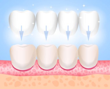 Kaplama, Lumineers, onley, microprosthesis. Kaplama montajı. Estetik Tıp. Yön diş hekimliği Ortopedi
