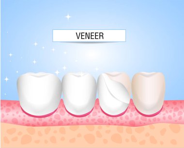 Kaplama, Lumineers, onley, microprosthesis. Kaplama montajı. Estetik Tıp. Yön diş hekimliği Ortopedi