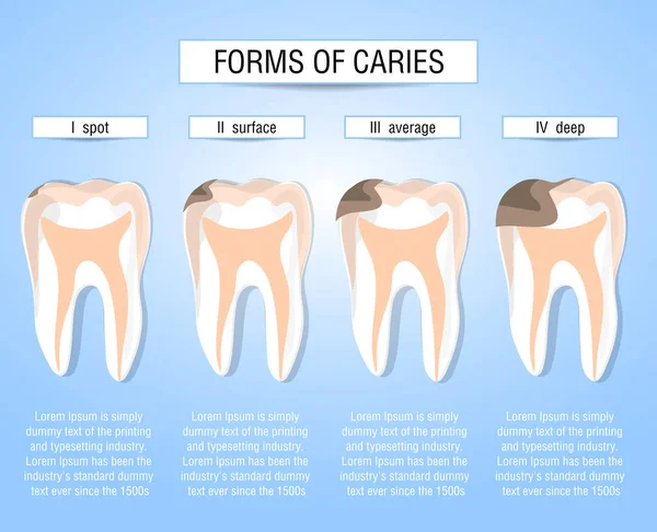 Формы Кариеса Этапы Развития Кариозного Процесса Визуальная Помощь Студентам Стоматологам — стоковый вектор