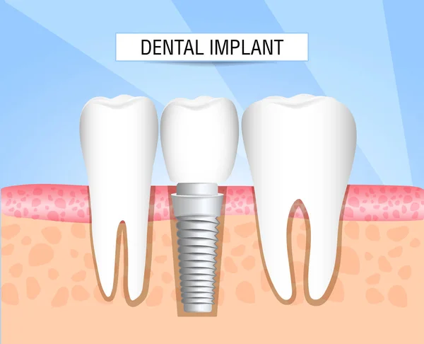 Gerçekçi implant diş yapısı ile tüm parçaları: crown, ayağına, vida. Sağlıklı dişler ve diş implantı. Diş Hekimliği. İnsan dişleri implantasyonu. Vektör çizim