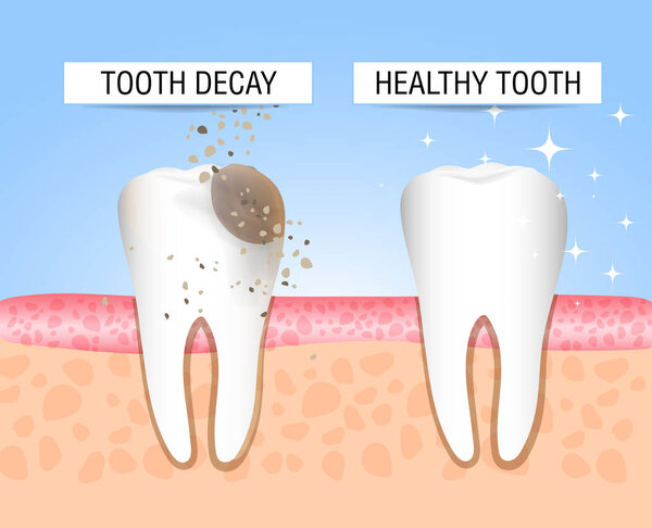 The concept of healthy and diseased tooth. Visual aid for students, dentists, patients of the clinic. Defeat caries, the focus of destruction in the teeth. Vector illustration