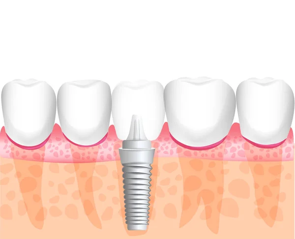 Gerçekçi implant diş yapısı ile tüm parçaları: crown, ayağına, vida. Sağlıklı dişler ve diş implantı. Diş Hekimliği. İnsan dişleri implantasyonu. Vektör çizim