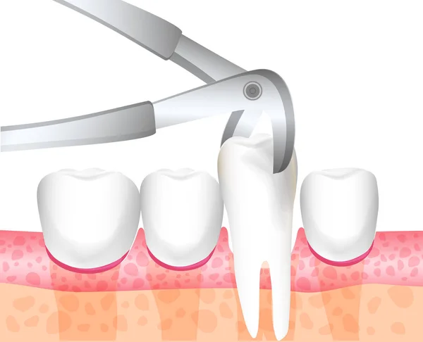 Zahnchirurgische Entfernung Des Zahnes Des Patienten Zahnwerkzeugzange Zahnmedizin Chirurgische Behandlung — Stockvektor