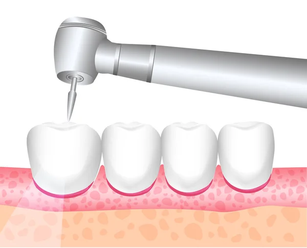 Zahnbehandlung Zahnmedizin Zahnarztinstrument Zahnbohrer Die Behandlung Von Zahnschmerzen Das Bohren — Stockvektor