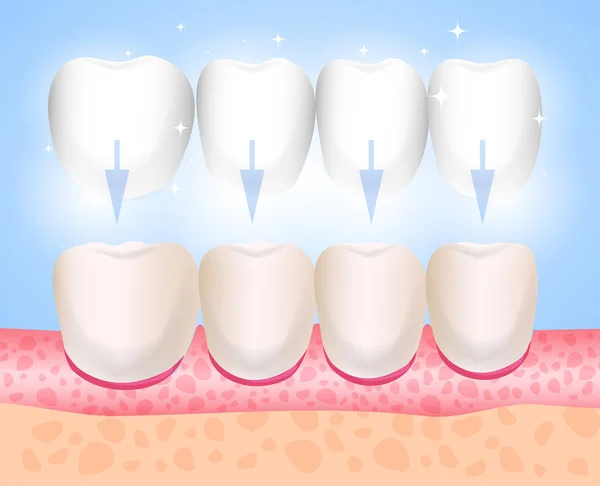 Kaplama, Lumineers, onley, microprosthesis. Kaplama montajı. Estetik Tıp. Yön diş hekimliği Ortopedi