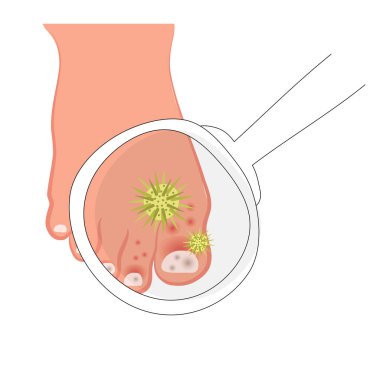 Etkilenmiş tırnakları olan bir insan ayağı. Mantar lezyonları, dermatit, nörodermatit, mikoz, sedef hastalığı. Deri hastalıklarının vektör çizimi