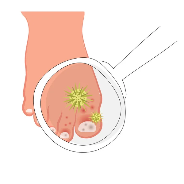 Ένα Ανθρώπινο Πόδι Προσβεβλημένα Νύχια Μυκητιασικές Βλάβες Δερματίτιδα Νευροδερματίτιδα Μυκητίαση — Διανυσματικό Αρχείο