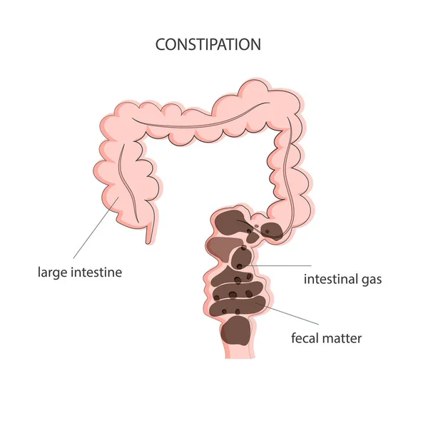 Fecal Obstruction Gas Accumulation Colon Medical Poster Constipation Vector Illustration — Stock Vector