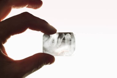 Hasta bir diş bir fotoğraf ışık karşısında bir el tarafından düzenlenmektedir