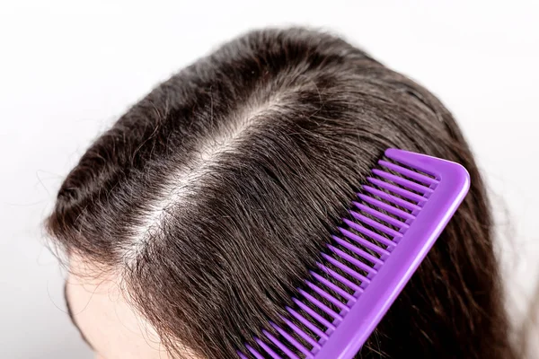 Woman Brunette Parting Her Hair Comb Showing Results Treatment Dandruff — Stock Photo, Image