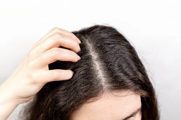 여자는 손으로 머리를 긁어서 민들레가 끝나는 보여준다 위에서 Dandruff Pediculosis — 스톡 사진